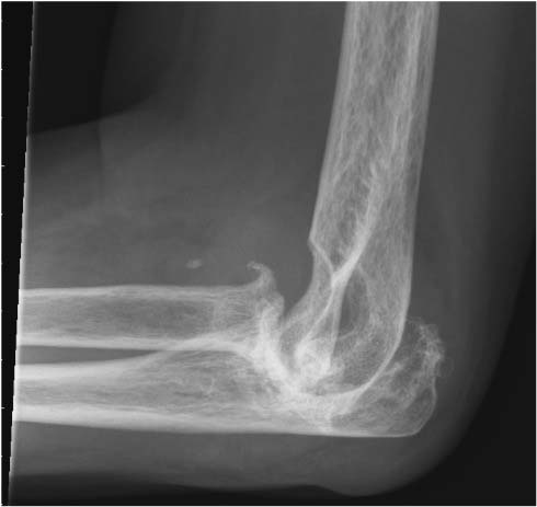 Elbow Arthritis UW Orthopaedic Surgery And Sports Medicine elbow-arthritis-uw-orthopaedic-surgery-and-sports-medicine